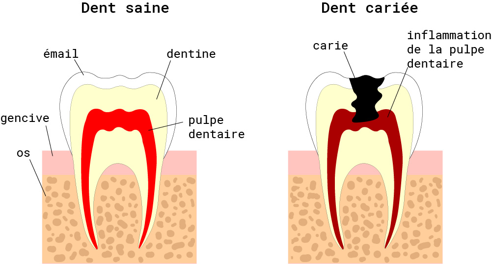 nos soins bucco-dentaire la carie dentaire