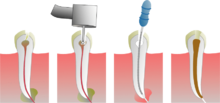 nos soins bucco-dentaires l'endodontie