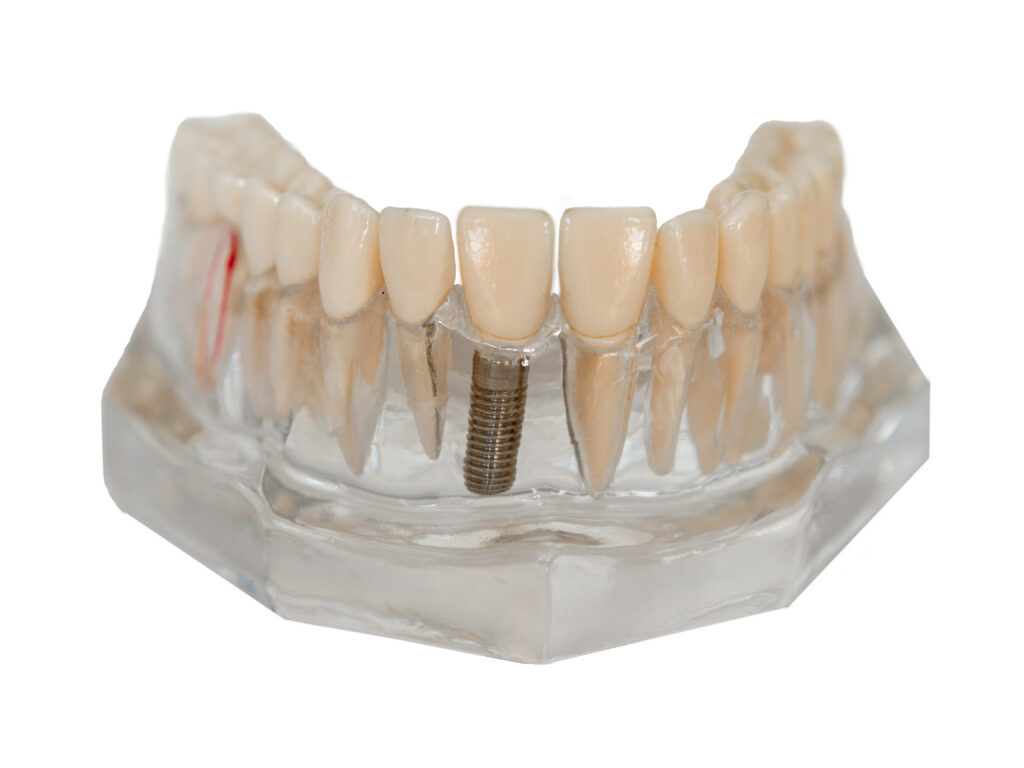 Couronne sur implant