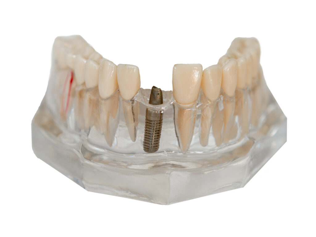 Implant en place avec inlaycore sur implant